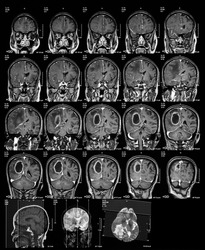 Magnetic resonance imaging (MRI) of the brain, brain tumor, brain abscess, coronal view.