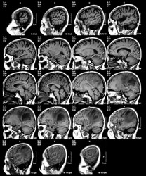 Magnetic resonance imaging (MRI) of the brain, brain tumor, brain abscess, sagittal view.