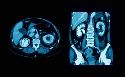 CT scan (computed tomography) of abdominal (urinary tract), showing right kidney stone