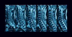 Magnetic resonance imaging (MRI) scan of cervical spine (C-spine), sagittal plane, case of nerve root compression and cervical spondylosis