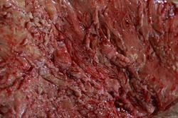 texture of the removed tumor macro