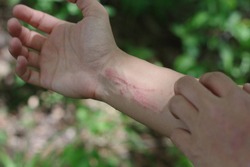 A woman scratching very itchy poison ivy while hiking in the woods