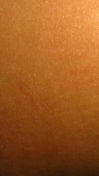 blurry and grainy picture of cracked skin due to itching on a brown skin
