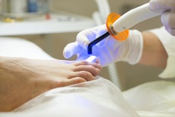 An orthopedist puts a metal nail clamp on an ingrown toenail. It shines with an ultraviolet lamp to harden the glue. Correction of nail deformity.