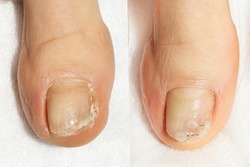 Collage. toes before and after the pedicure procedure with the installation of a metal titanium corrective brace for the treatment of ingrown toenails and deformation of the nail plate