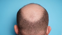 Hair loss in men. Bald head of an adult man from the back. Alopecia on the head.