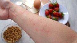 Close up image of arm suffering severe urticaria or hives or kaligata with ilustration of allergy trigger foods.  Eggs, milk, beans, strawberry, and chesse.
