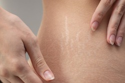 Woman hips with visible stretch marks. Young woman showing Stretch mark scars on her body.