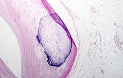 Artery calcification, narrowing of artery, light micrograph, photo under microscope