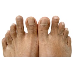 Male Feet with second toe longer than big primary toe, which is known as Morton's toe. Isolated on white background.