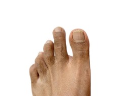 Male Left Foot with second toe longer than big primary toe, which is known as Morton's toe. Isolated on white background.