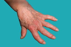 An image of the hand of an elderly woman suffering from arthritis of the hands. Hand of a patient with rheumatic arthritis close-up. Joint deformity and wrinkled skin. Arthritis of the hands