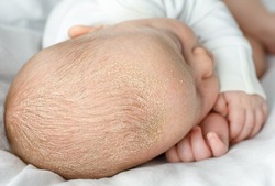seborrheic dermatitis crusts on the baby's head. child with seborrhea in the hair, newborn skin problems
