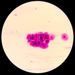 Microscopic image of Cervical smear (paps) cytology, reactive cellular changes associated with severe inflammation, cluster of epithelial cells, 40X focus view