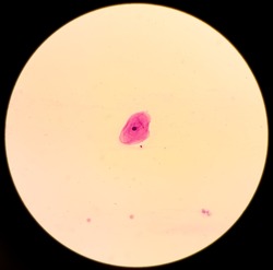 Photomicrograph of Cervical smear (paps) cytology, reactive cellular changes associated with severe inflammation, single epithelial cell, 40x view