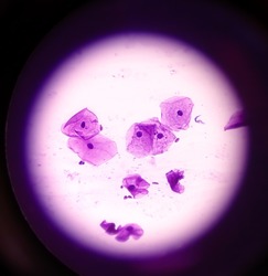 Cervical smear (paps) cytology at histopathology laboratory. Microscopic 40x objective view of reactive cellular changes associated with severe inflammation, selective focus