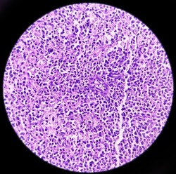 Inguinal lymph node: Non-Hodgkin's lymphoma,high grade, reveals monotonous population of atypical lymphoid cells arranged diffusely, light micrograph, photo under microscope