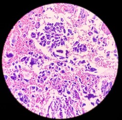 Bone cancer, photo of osteosarcoma in the bone, It's very rare cancer, magnification 40x, photo under light microscope
