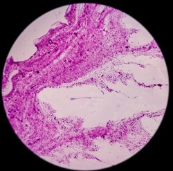 Lung mass(CT Guided FNA): Inflammatory lesion, microscopy show polymorphs, lymphocytes, histiocytes, reactive bronchial cells. No malignant cell.