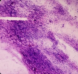 Conventional pap's smear: Reactive cellular changes associated with severe inflammation, atypical squamous cells of undetermined significance(ASCUS), selective focus