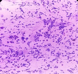 Conventional pap's smear: Reactive cellular changes associated with severe inflammation, atypical squamous cells of undetermined significance(ASCUS), selective focus