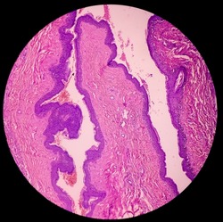 Preputial skin(biopsy): Chronic nonspecific inflammation with dysplasia. Microscopic show dense infiltration of polymorphs, lymphocytes and histiocytes, focal area mild dysplasia.