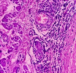 Preputial skin(biopsy): Chronic nonspecific inflammation with dysplasia. Microscopic show dense infiltration of polymorphs, lymphocytes and histiocytes, focal area mild dysplasia.