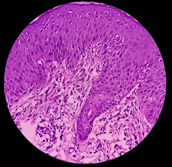 Skin tissue(biopsy): Pityriasis lichenoids chronica, a group of rare acquired inflammatory skin disorders. Epidermis show mild hyperkeratosis and acanthosis, focal exocytosis of lymphocytes.