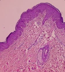 Skin tissue(biopsy): Pityriasis lichenoids chronica, a group of rare acquired inflammatory skin disorders. Epidermis show mild hyperkeratosis and acanthosis, focal exocytosis of lymphocytes.