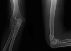 Radial head fracture x ray radiology