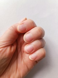 Untidy uneven female nails with regrown cuticles on a white background. health, beauty and hygiene concept. selective focus.
