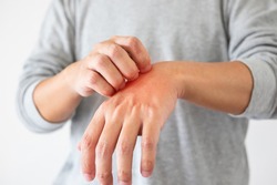 Young asian man itching and scratching on hand from itchy dry skin eczema dermatitis