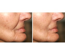 Wrinkles on the face. Flabby skin on the cheeks, Nasolabial wrinkle. Before and after treatment.