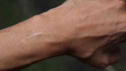 man's veins with stitches on his wrists. Scar with stitches on the wrist.