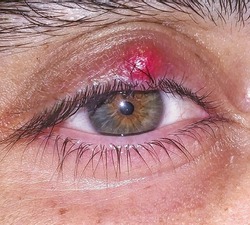 Close-up of a chalazion hordeolum (Stye)
on the eyelid  on young male eye.Chalazion is a less painful chronic infection on the inside edge of the eyelid 