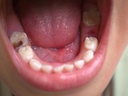 Child patient open mouth showing caries teeth decay. closeup photo, blurred.