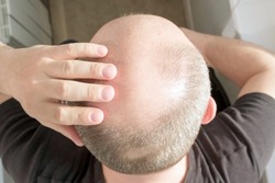 Baldness, man concerned about hair loss. Male head with bald. Male pattern baldness. Fighting hair loss in men