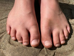 Barefoot young boy with webbed toe, syndactyly of the middle toes on right foot. Genetic congenital conditions and common birth abnormalities.
