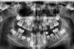 x-ray of the jaw of an 8-year-old child