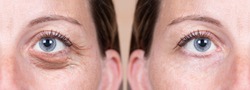 A 40 year old Caucasian woman shows the before and after results of blepharoplasty. Plastic surgery to remove dark puffy eyebags from the delicate area below the eyes.
