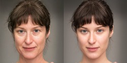 Same face of woman before and after a rejuvenation treatment. Wrinkles and crow's feet
