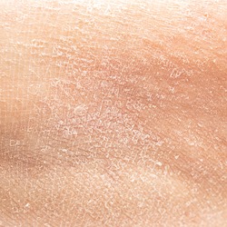 Dry human skin of a woman leg. Concept of skin rehydration cosmetics to keep the skin young
