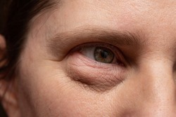 Closeup of a puffy eye with dark bags under the eyelid due to stress or bad water retention