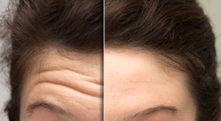 face of a woman before and after a cosmetic treatment to smooth expression lines. Concept of anti-aging and rejuvenation cosmetics on forehead wrinkles