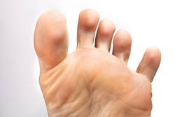 Closeup of a female foot with toes apart to inspect athlete's foot, isolated on white background. Concept of hygiene, fungal infections and onychomycosis