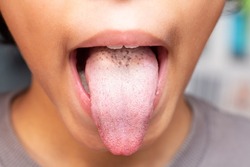 Close up shot caucasian girl show her tongue for doctor check white tongue.Concept for Symptoms of virus,  disease and bacteria in tongue concept