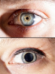 Macro view side by side image diluted eye pupils and pupil dilation affected by flash light.