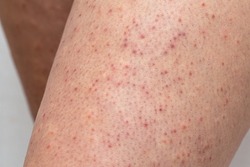 Legskin macro of a young woman suffering from pillar keratosis, frequent cause of atopic dermatitis and sketchy