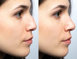 Closeup of a young woman's nose before and after nasal filler surgery. Rhinoplasty without surgery but with temporary injections of hyaluronic acid based fillers.