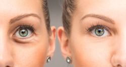 Eyes of woman with and without eye bag before and after cosmetic treatment